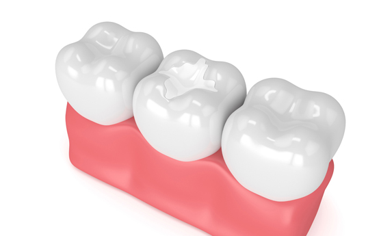 Why Are Dental Fillings Needed.jpg