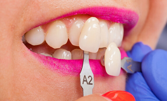 why would porcelain veneers be needed 2 new
